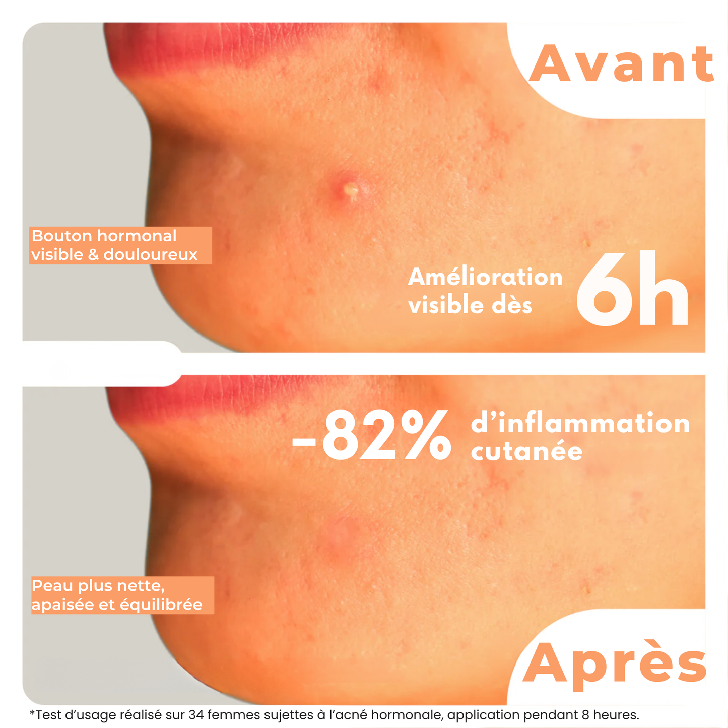 CycleClear® - Patchs Jour & Nuit pour l’Acné Hormonale
