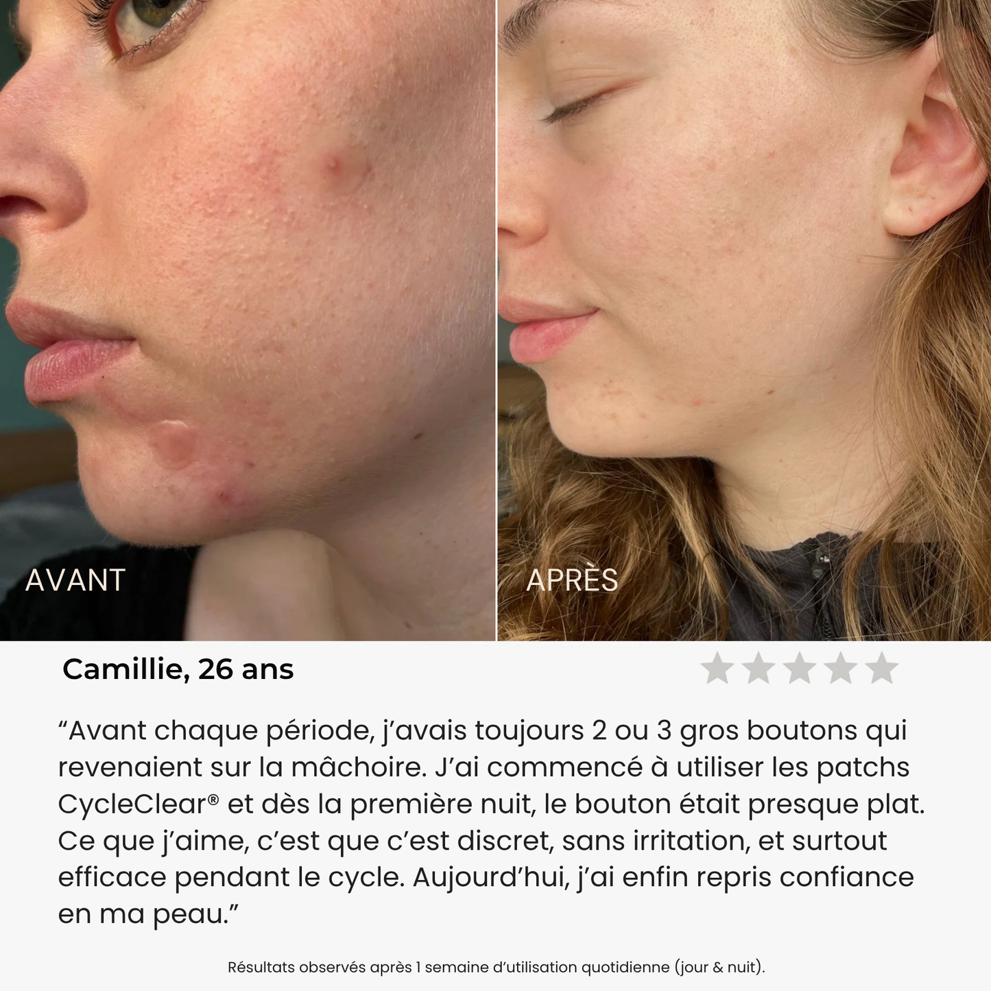 CycleClear® - Patchs Jour & Nuit pour l’Acné Hormonale