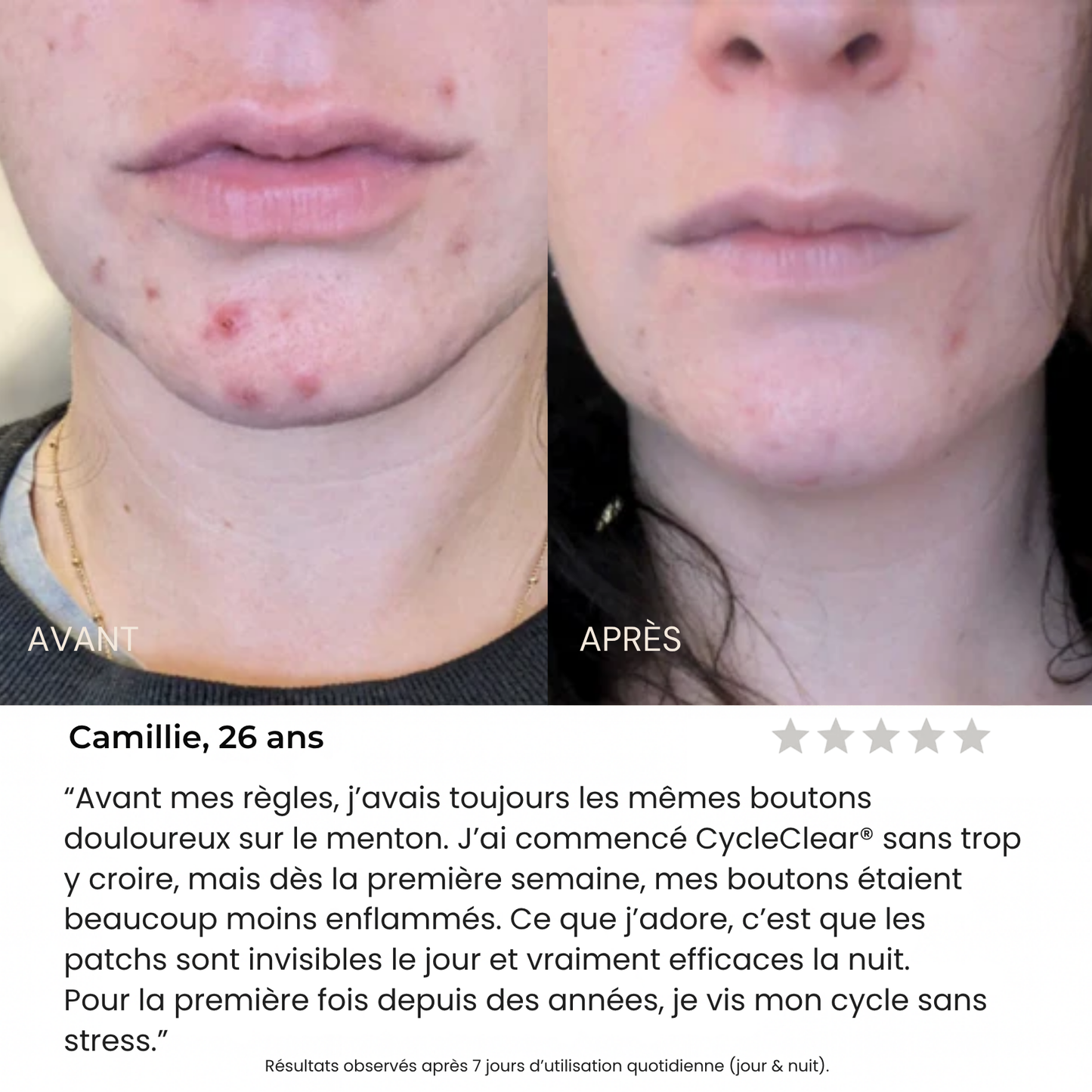 CycleClear® - Patchs Jour & Nuit pour l’Acné Hormonale