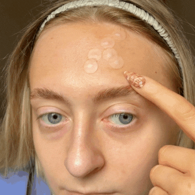 CycleClear® - Patchs Jour & Nuit pour l’Acné Hormonale