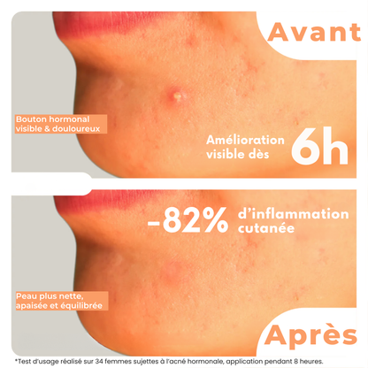 CycleClear® - Patchs Jour & Nuit pour l’Acné Hormonale